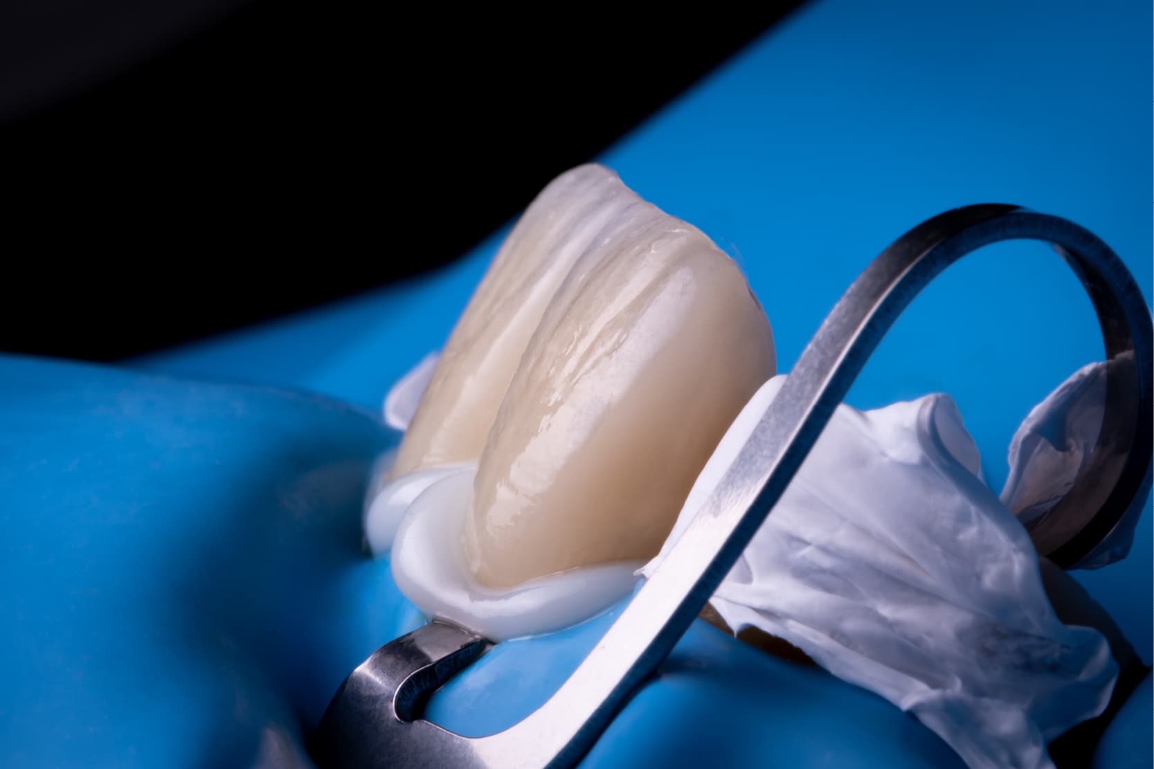 Classification of dental cements for dental prostheses