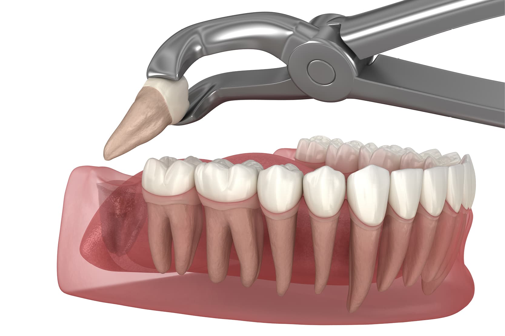 Dental autotransplants: evidence in the literature