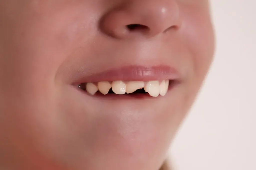 traumi dentali